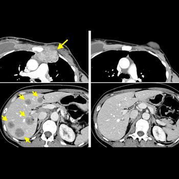 Inmunoterapia logra por primera vez eliminar cáncer de mama