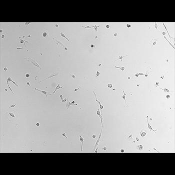 Una muestra de sangre permitiría diagnóstico temprano de leucemia