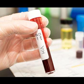 Avances hacia la cura del VIH: Logran eliminar el virus en seis pacientes con trasplantes de células madre