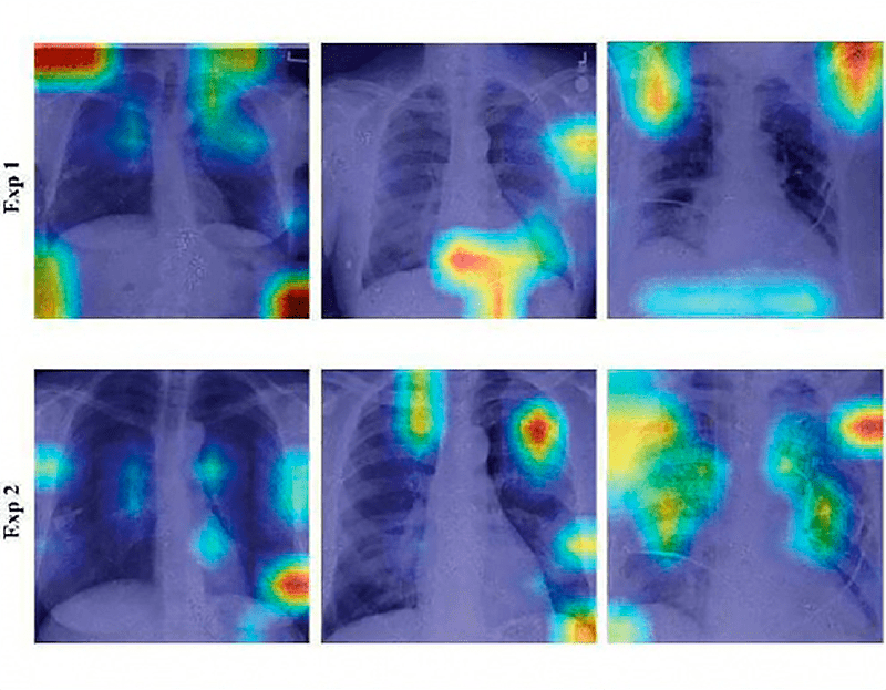 Inteligencia artificial para el diagnóstico de la COVID-19: análisis automático de radiografías simples de tórax